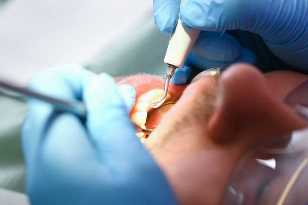 Best Chipped Tooth Repair Near Me  in Lackawanna, NY